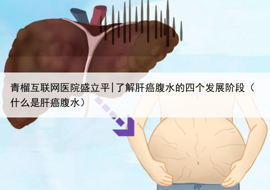青榴互联网医院盛立平|了解肝癌腹水的四个发展阶段（什么是肝癌腹水）