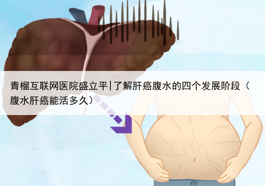青榴互联网医院盛立平|了解肝癌腹水的四个发展阶段(腹水肝癌能活多久)