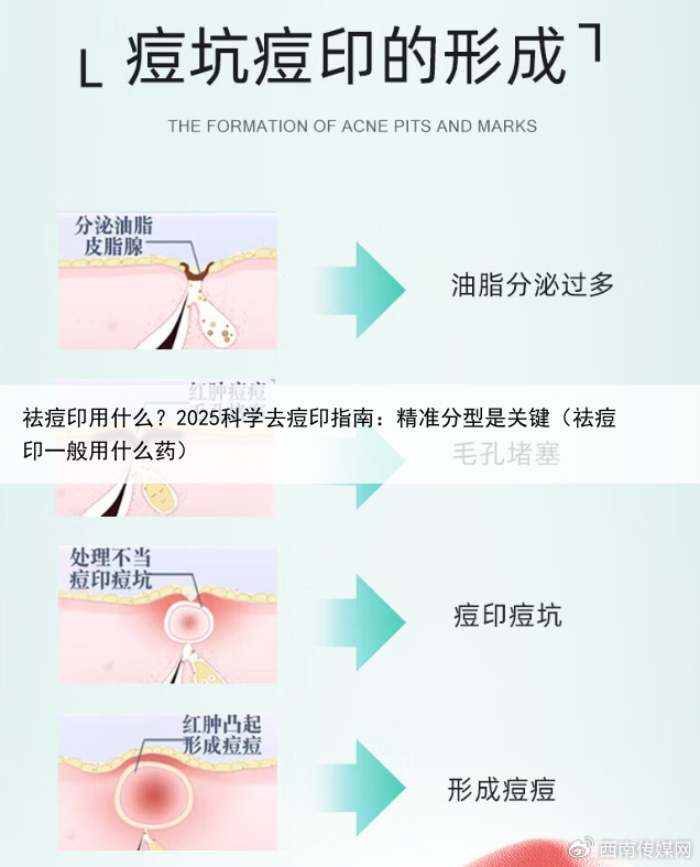 祛痘印用什么?2025科学去痘印指南:精准分型是关键(祛痘印一般用什么药)