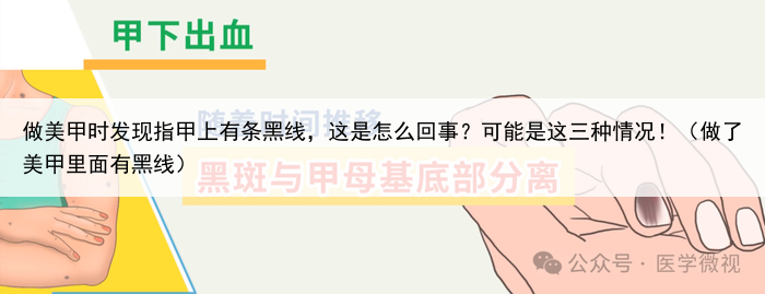 做美甲时发现指甲上有条黑线，这是怎么回事？可能是这三种情况！（做了美甲里面有黑线）